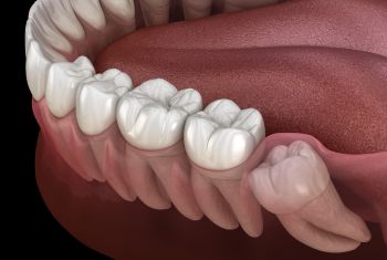 wisdom teeth removal in vzag