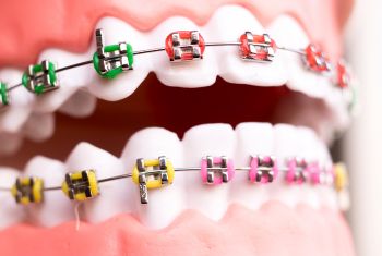 invisible aligners vs dental braces - best dental hospital in vizag