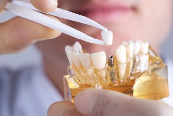 dental implants in vizag