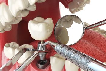 Best dental implant in vizag