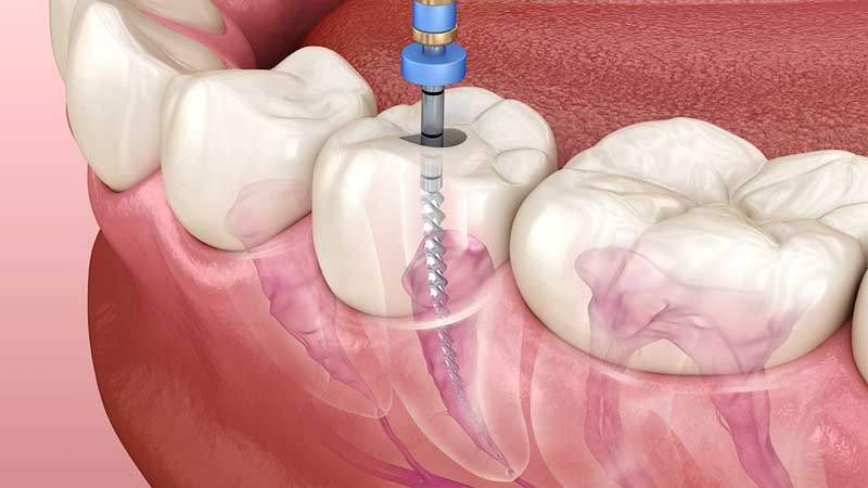 Unlocking the Secrets of Root Canal Treatment at V Dental Hospital