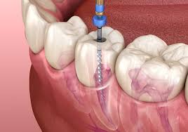 Best Root Canal Treatment in Vizag with Expert Doctors at Affordable Prices