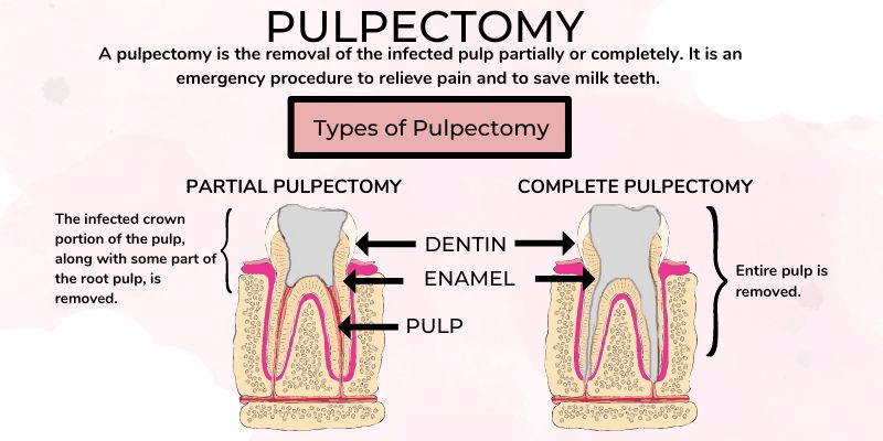 PULPECTOMY