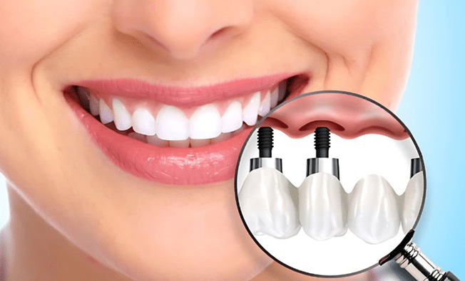 Dental Implants: The Long-Term Solution for a Confident Smile