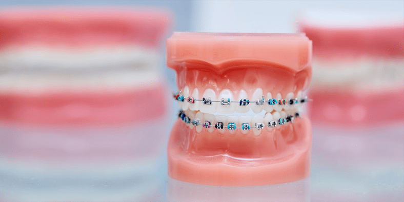 Early Orthodontic Intervention: Why Age Matters for Braces and Aligners