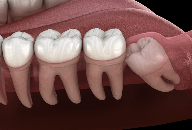 Wisdom Teeth: When to Remove and What to Expect