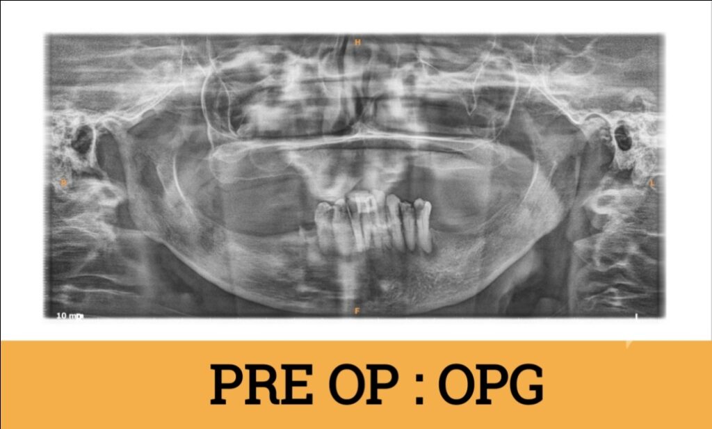 Fixed Teeth in 3 days