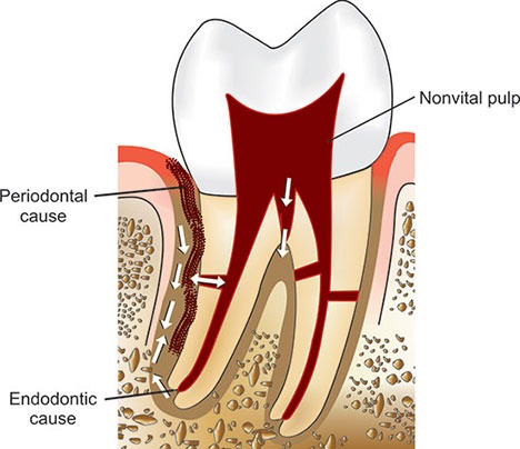 root canal treatment