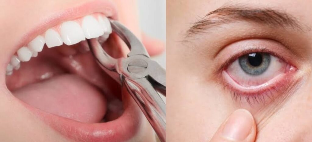 Tooth Extraction Cause Eye Problems