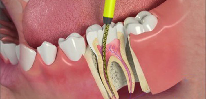 Root Canal Treatment in Srikakulam