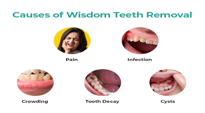 Wisdom Teeth: Removal, Recovery & Why It Sometimes Causes Problems